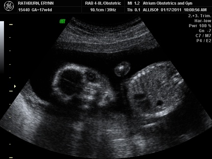 Ultrasound 17Jan2011